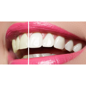 Bezpečné laserové bielenie zubov s nulovým obsahom peroxidu